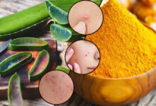 Aloe vera and turmeric for pimples