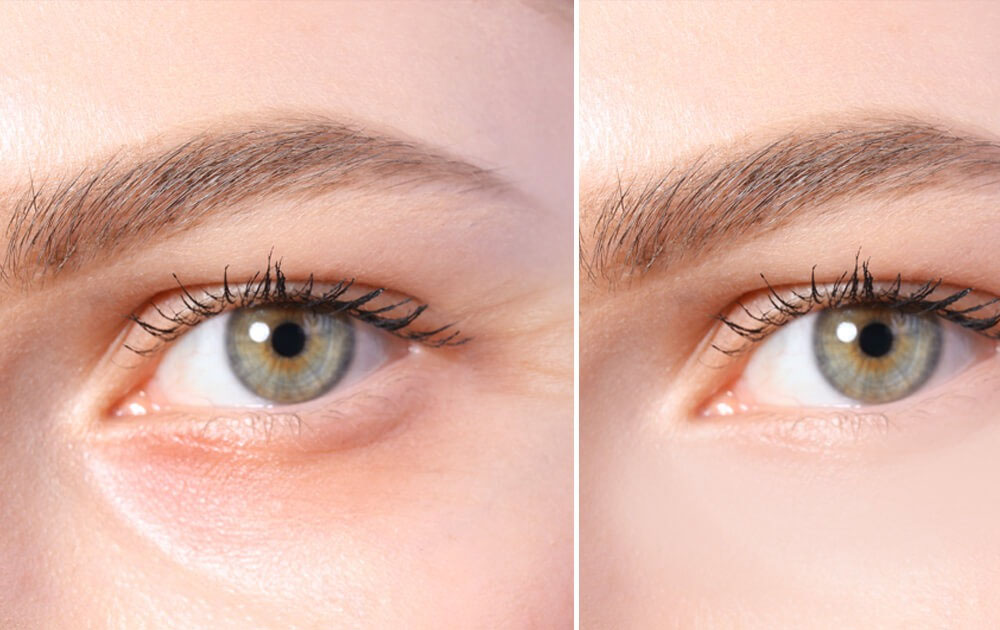 How To Remove Wrinkles Under Eyes Naturally